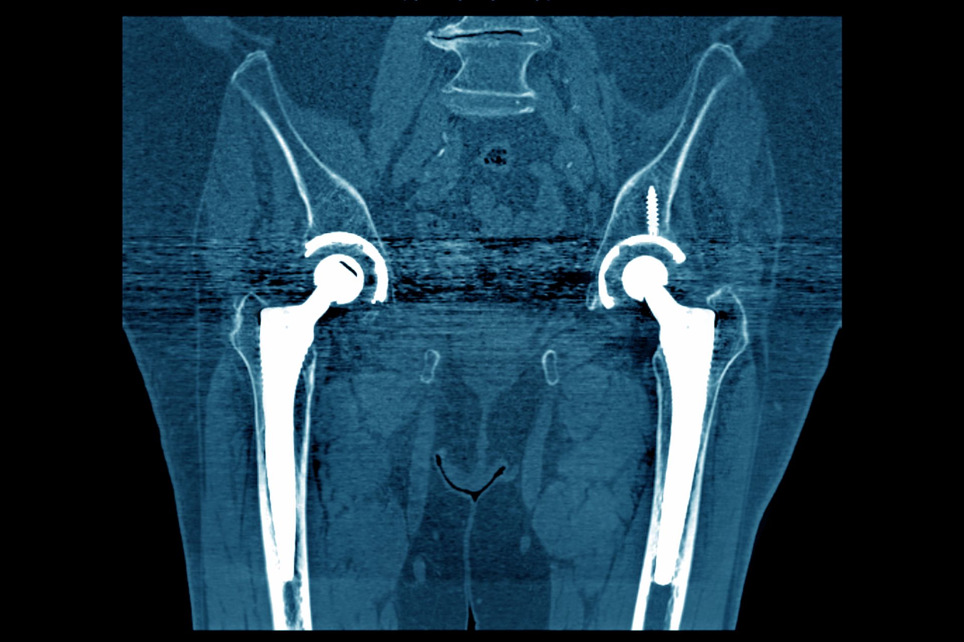 Johnson & Johnson settling hip implant lawsuits for 1 billion Axios