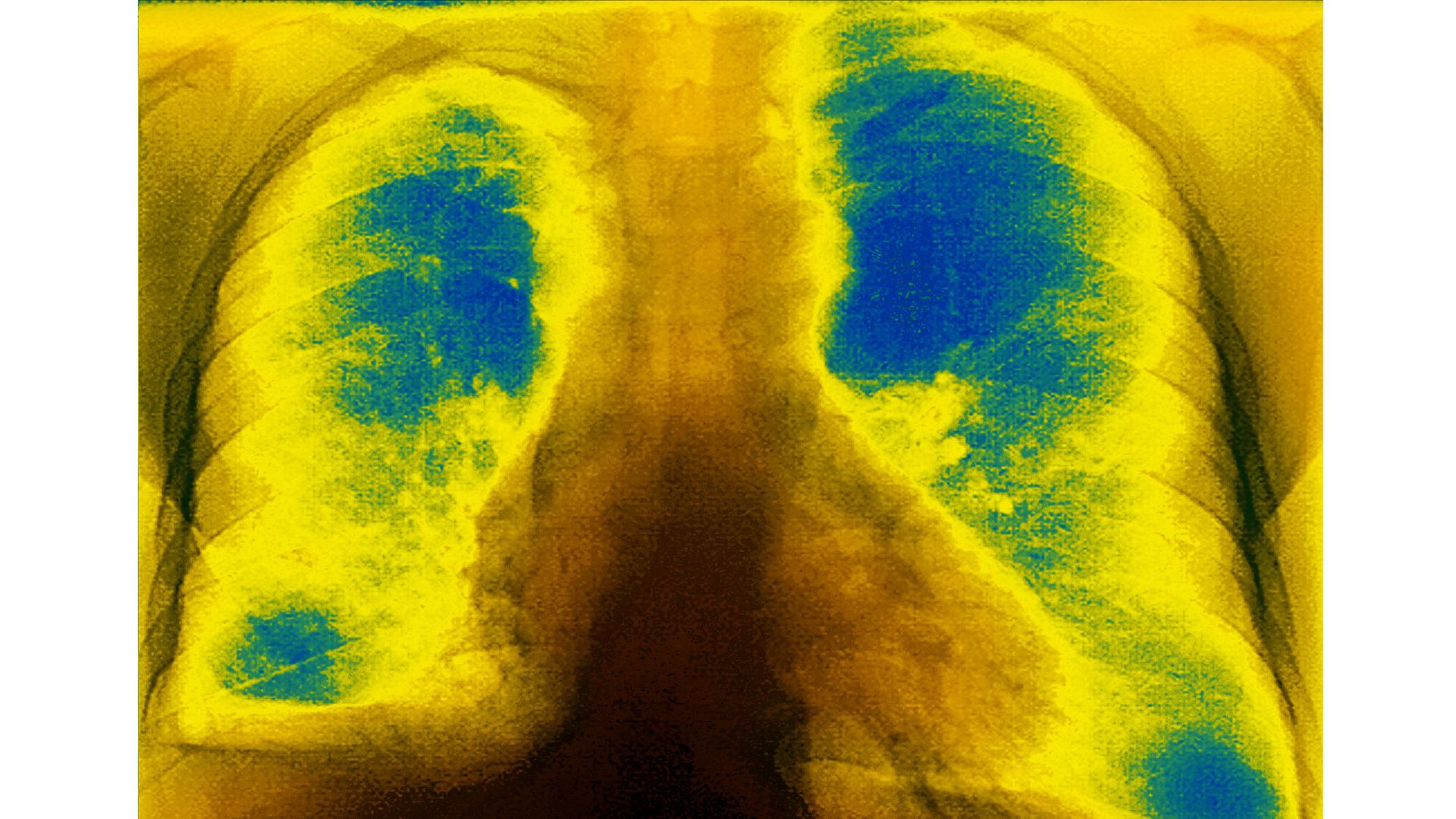 Mucoviscidosis (accumulation of mucus in the respiratory tract), seen on a frontal x-ray of the chest. (Photo by: BSIP/Universal Images Group via Getty Images)
