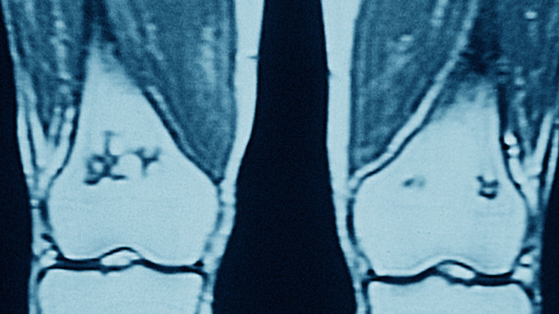 MRI of knees damaged by osteoarthritis