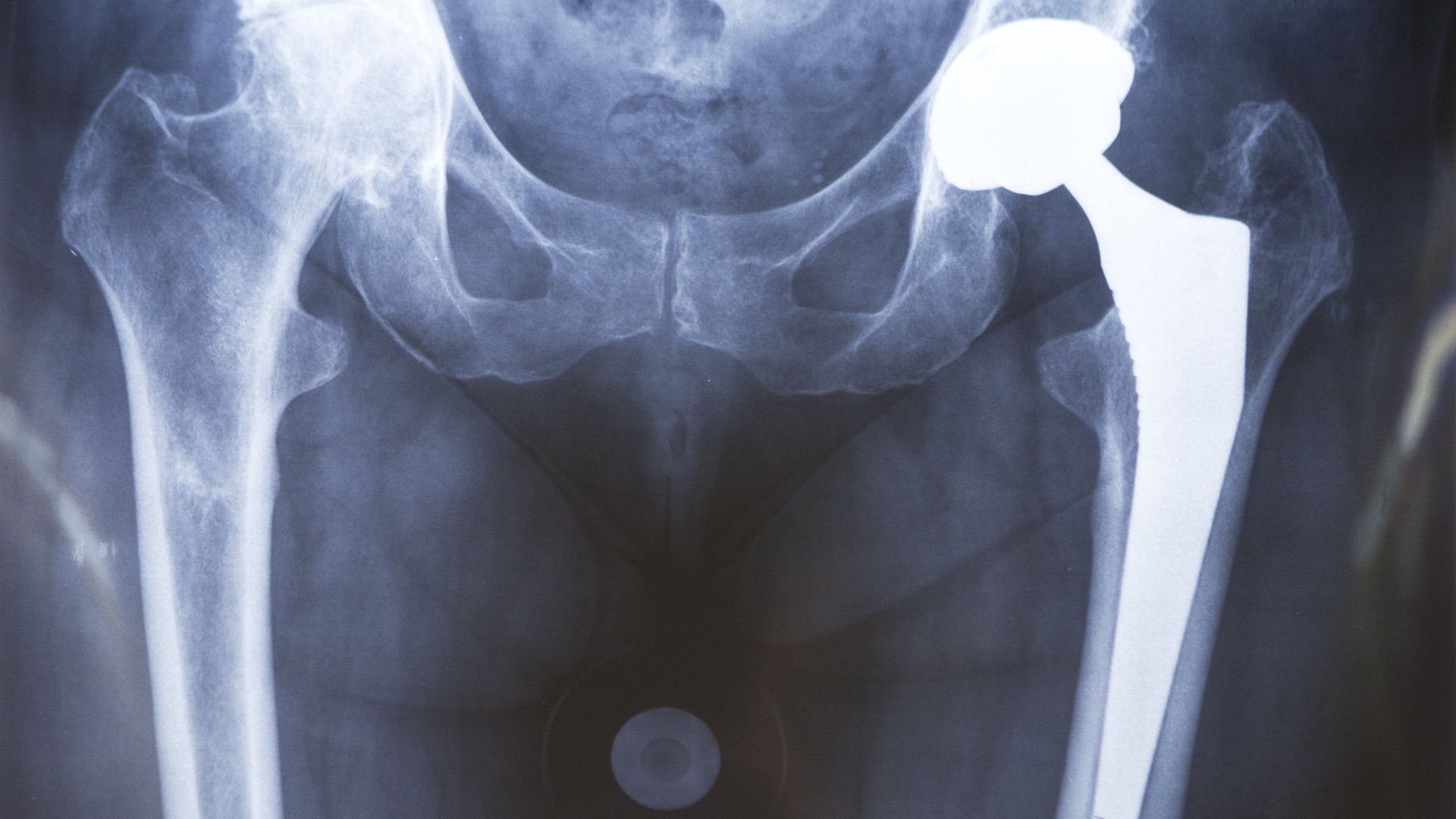 Hip Prosthesis, Surgery X-rays (Photo by: BSIP/Universal Images Group via Getty Images)