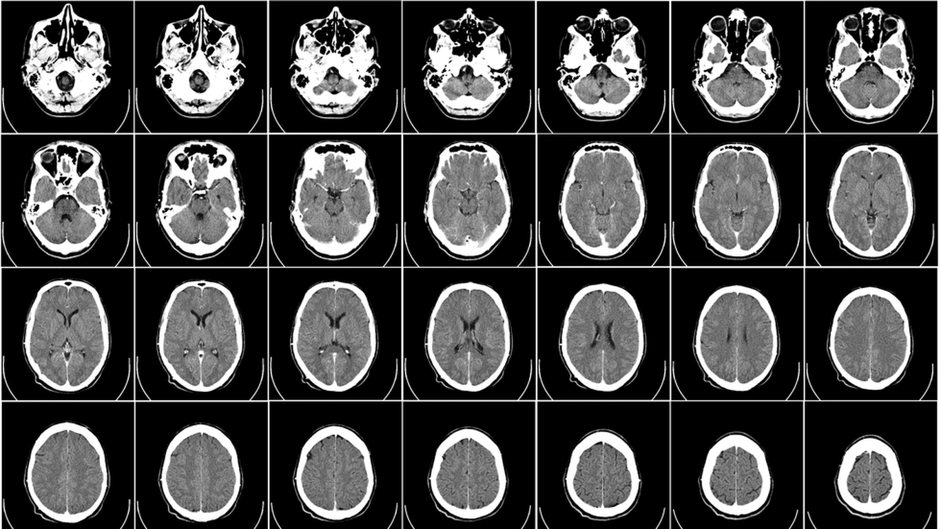 Scientists identify the different genes behind common childhood