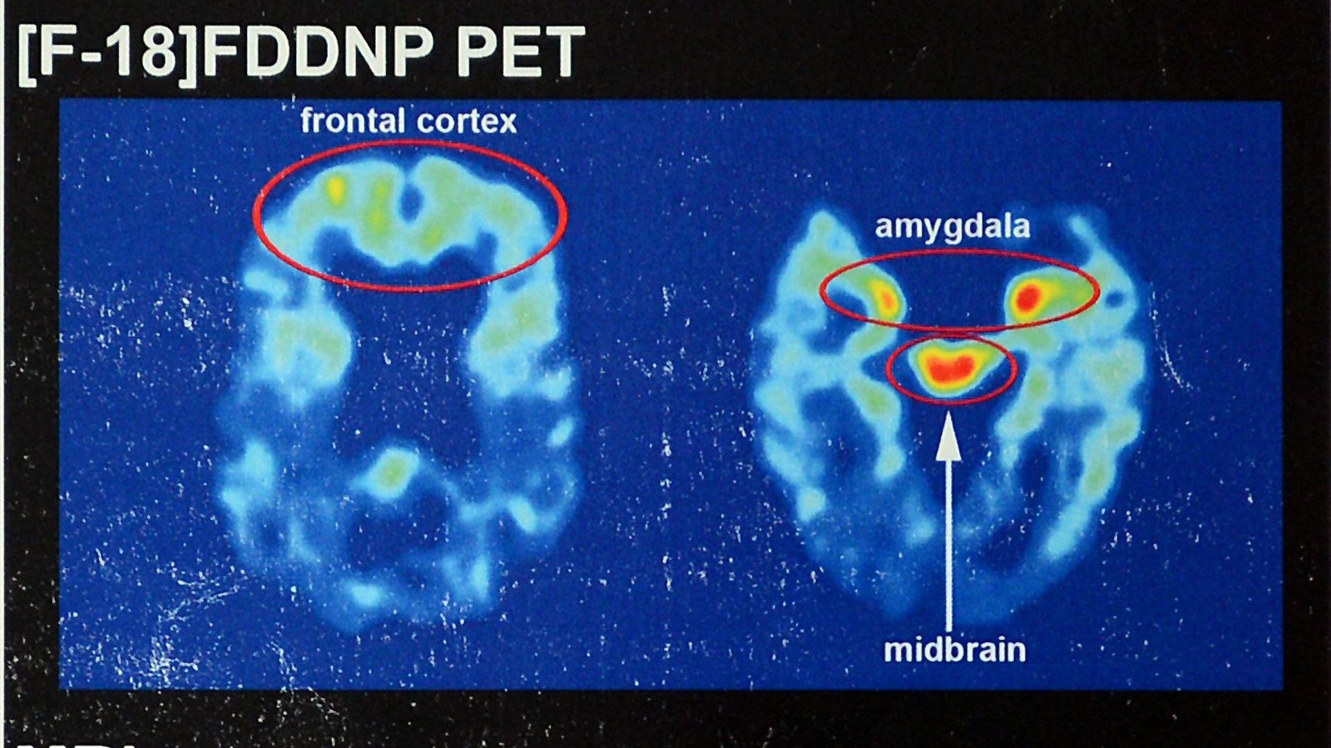 Brain scans of NFL hall of famer Joe DeLamielleure, who was diagnosed with CTE, the brain injury that is affecting so many former football players. (Jeff Siner/Charlotte Observer/Tribune News Service via Getty Images)