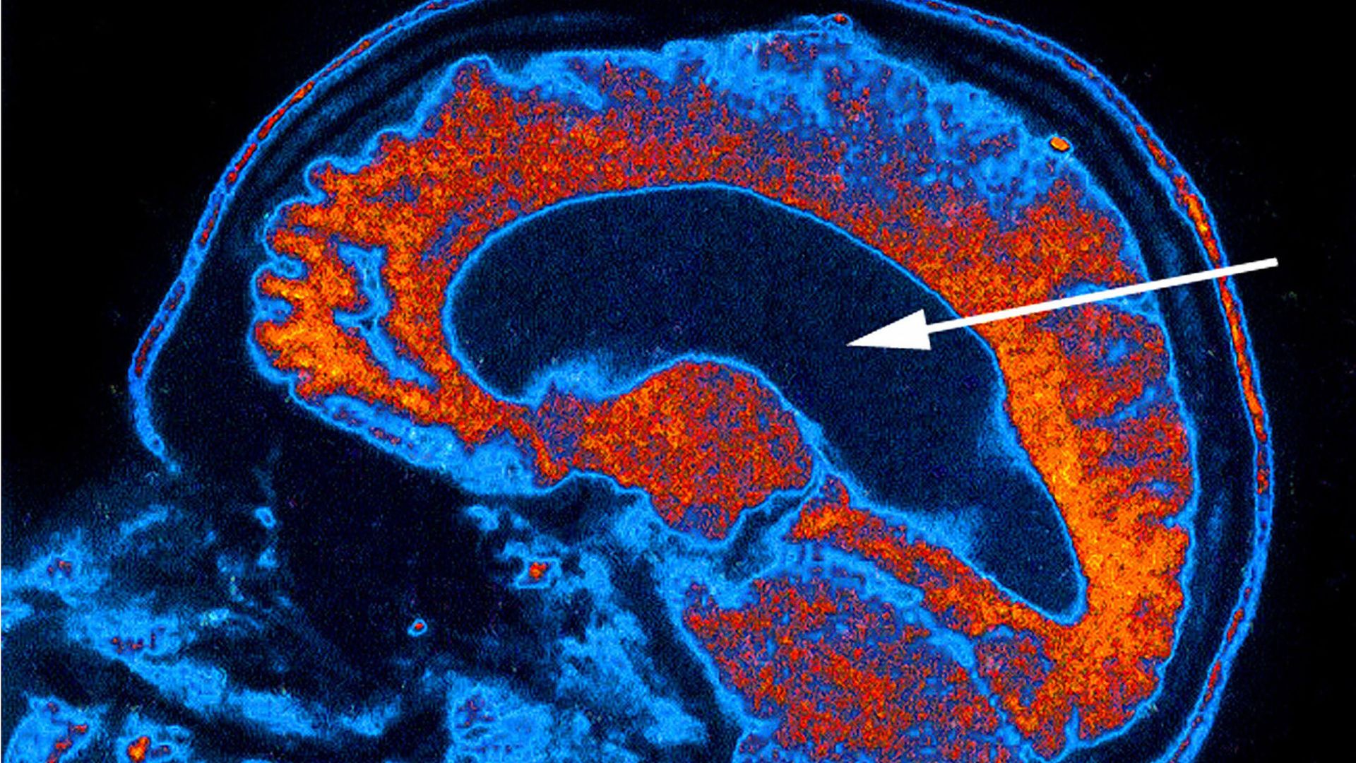 Hydrocephalus from a scan.