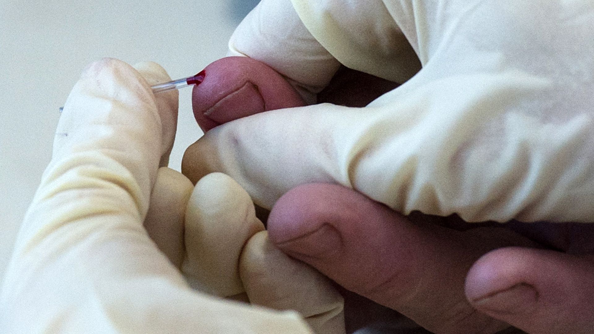 A blood sample is collected at a medical center in the Krasnoyarsk Territory of Russia on April 16, 2018. Photo: Kirill Kukhmar\TASS via Getty Images