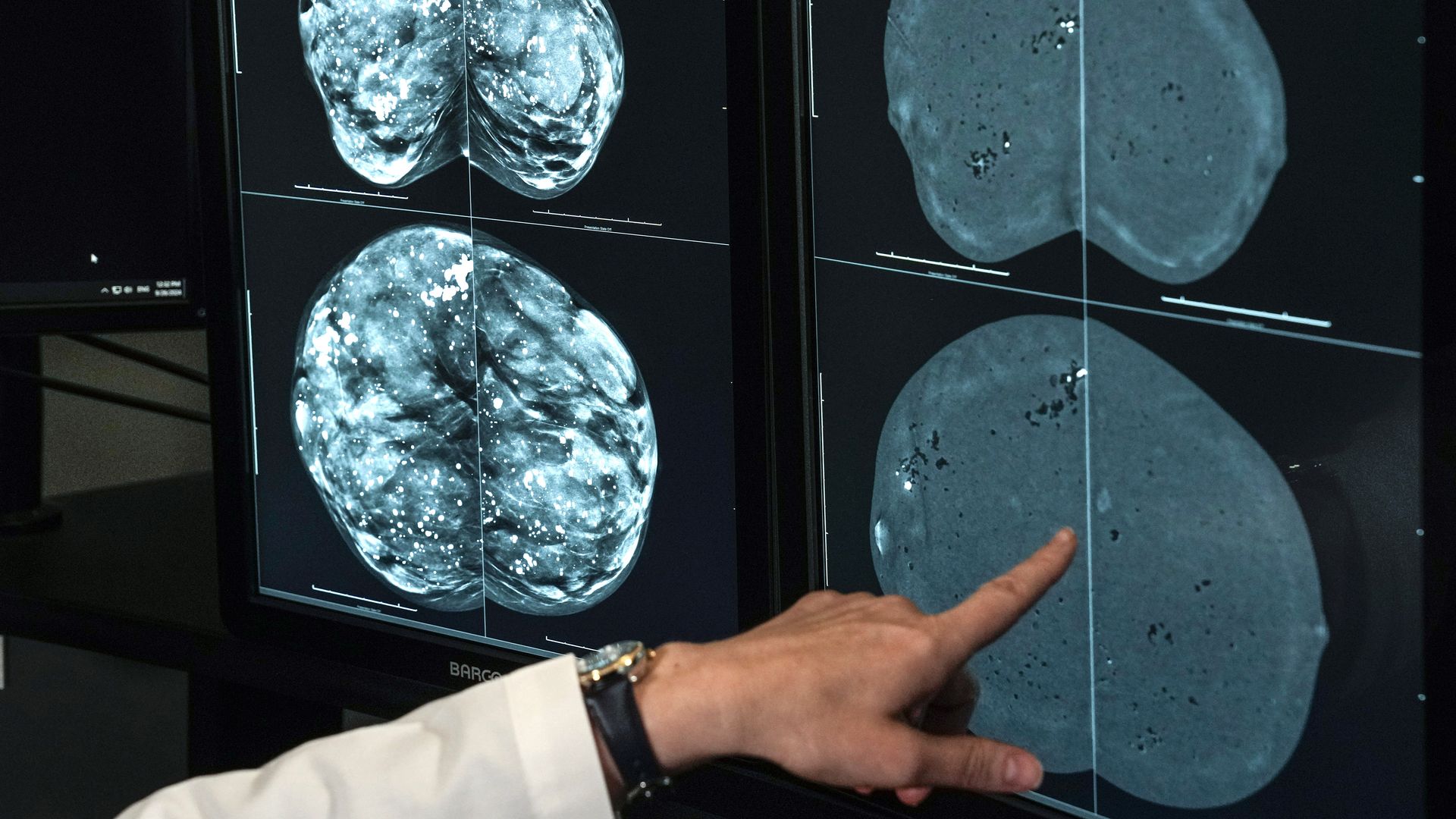 HOUSTON, TEXAS - SEPTEMBER 26: Dr. Olena Weaver, an Associate Professor in the Department of Breast Imaging at The University of Texas MD Anderson Cancer Center, looks at mammogram imagery, regular mammogram on the left, and contrast enhanced mammogram on the right, on Thursday, Sept. 26, 2024 in Ho