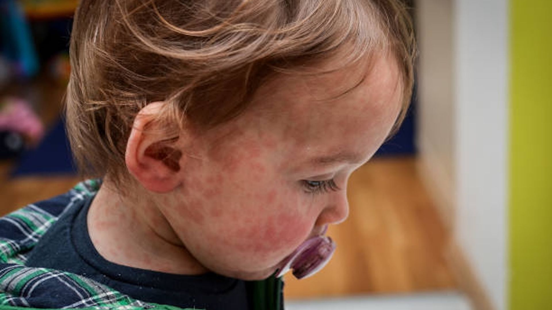 A young child with a rash from measles, with a pacifier in their mouth. 