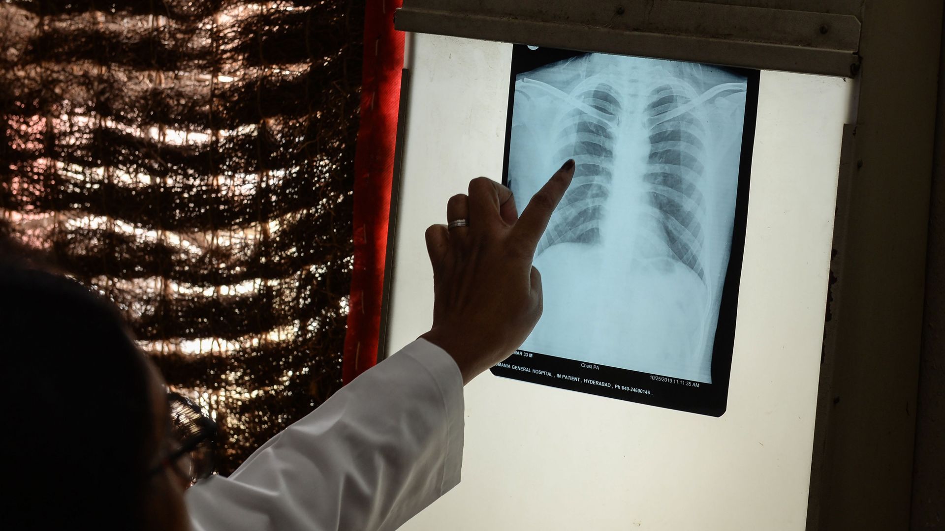A doctor checks the chest X-ray of a patient in the tuberculosis (TB) department of the government-run Osmania General Hospital in Hyderabad, India.